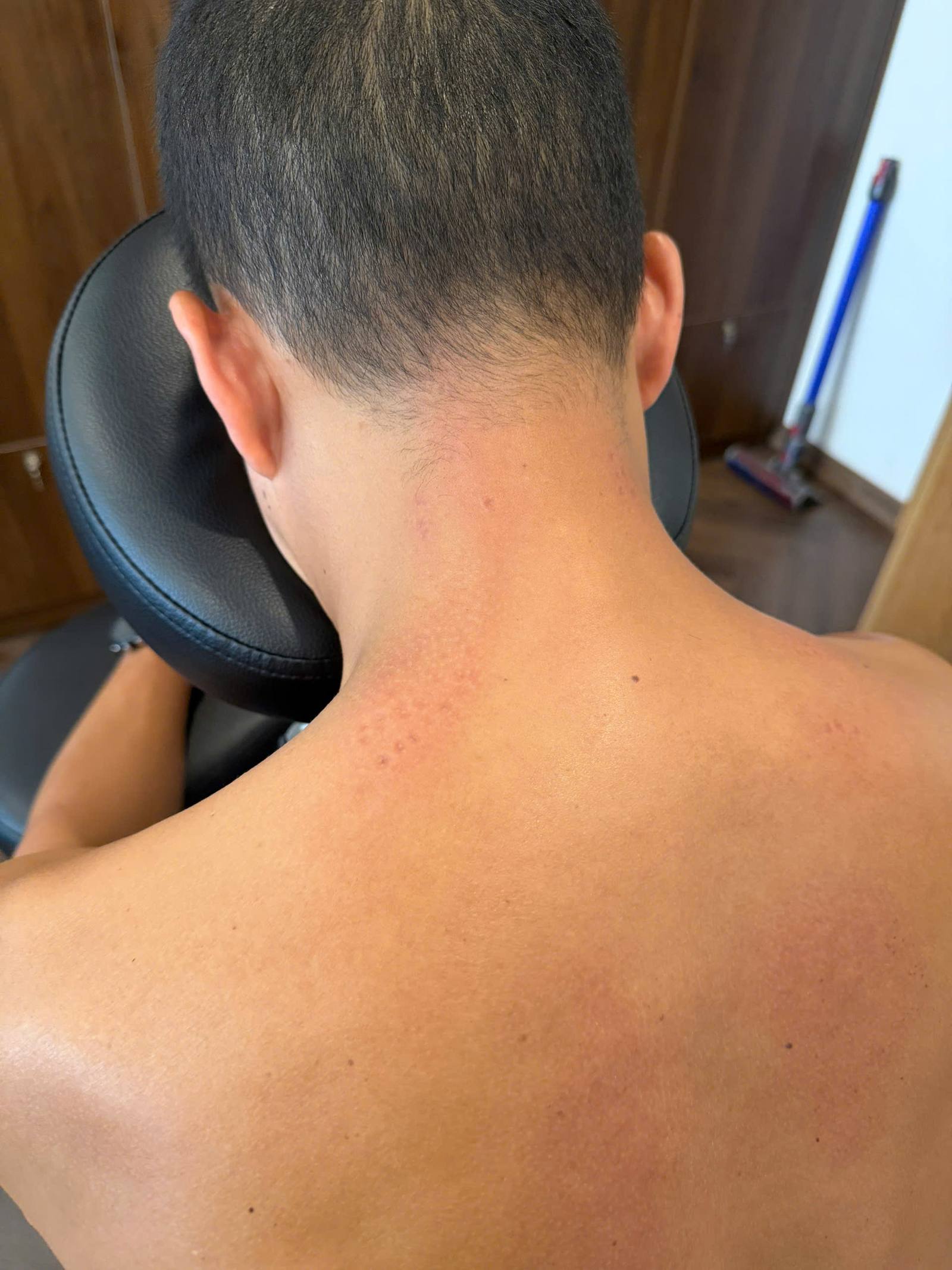 Vùng cổ vai gáy sau buổi trị liệu — các chấm đỏ nhỏ nổi đúng tại những điểm bó cơ vừa được tách xơ
