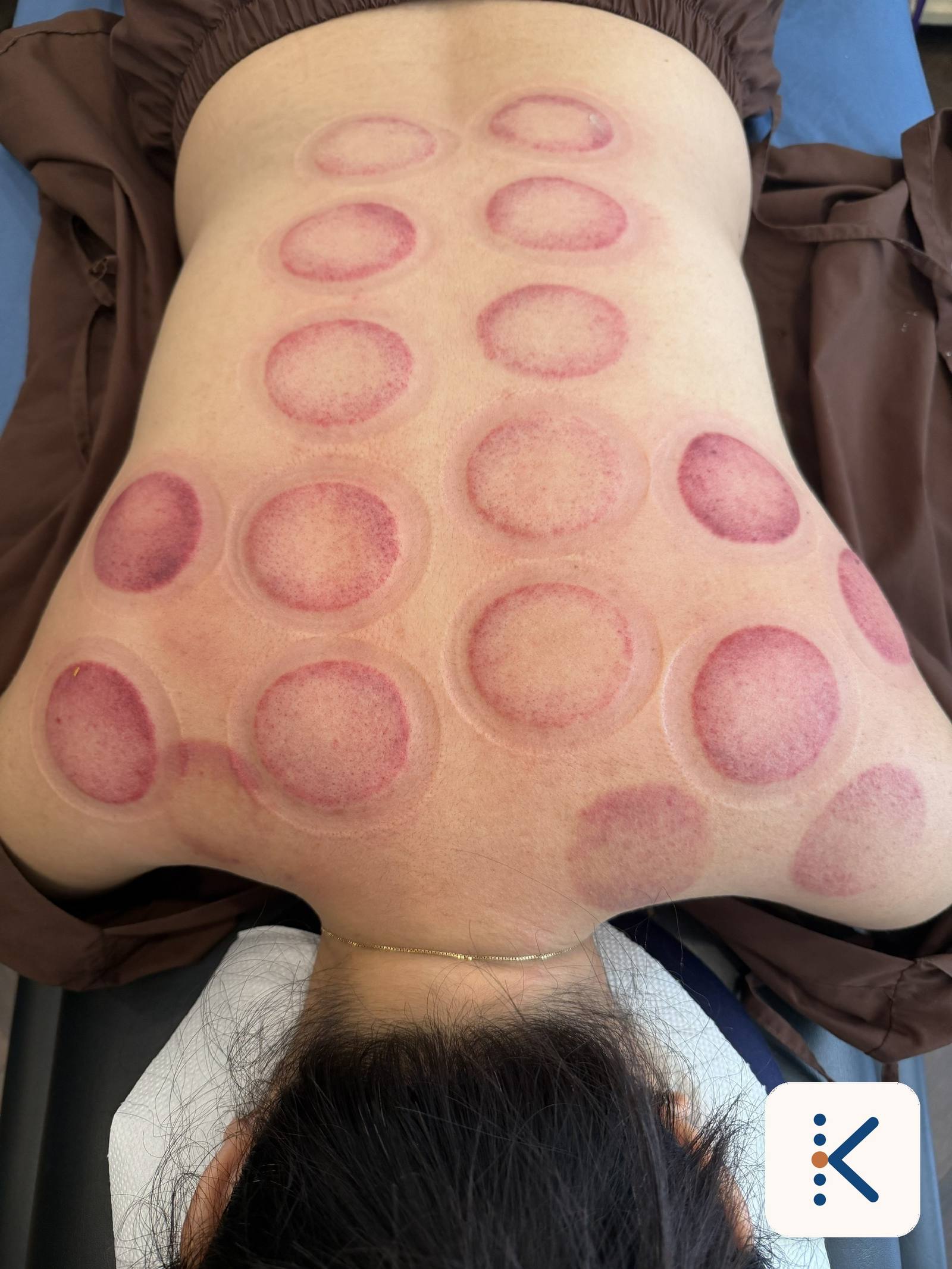 Các vết giác hơi lên màu khác nhau trên cùng một lưng — có điểm chỉ hồng nhạt, có điểm tím đậm