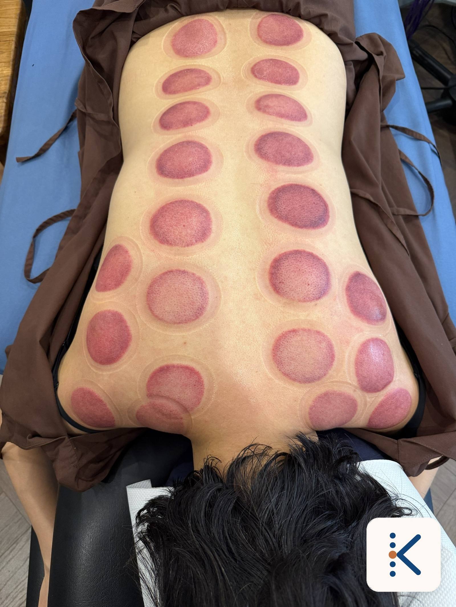 Vết giác hơi trên lưng sau buổi trị liệu tại Nguyễn Khương