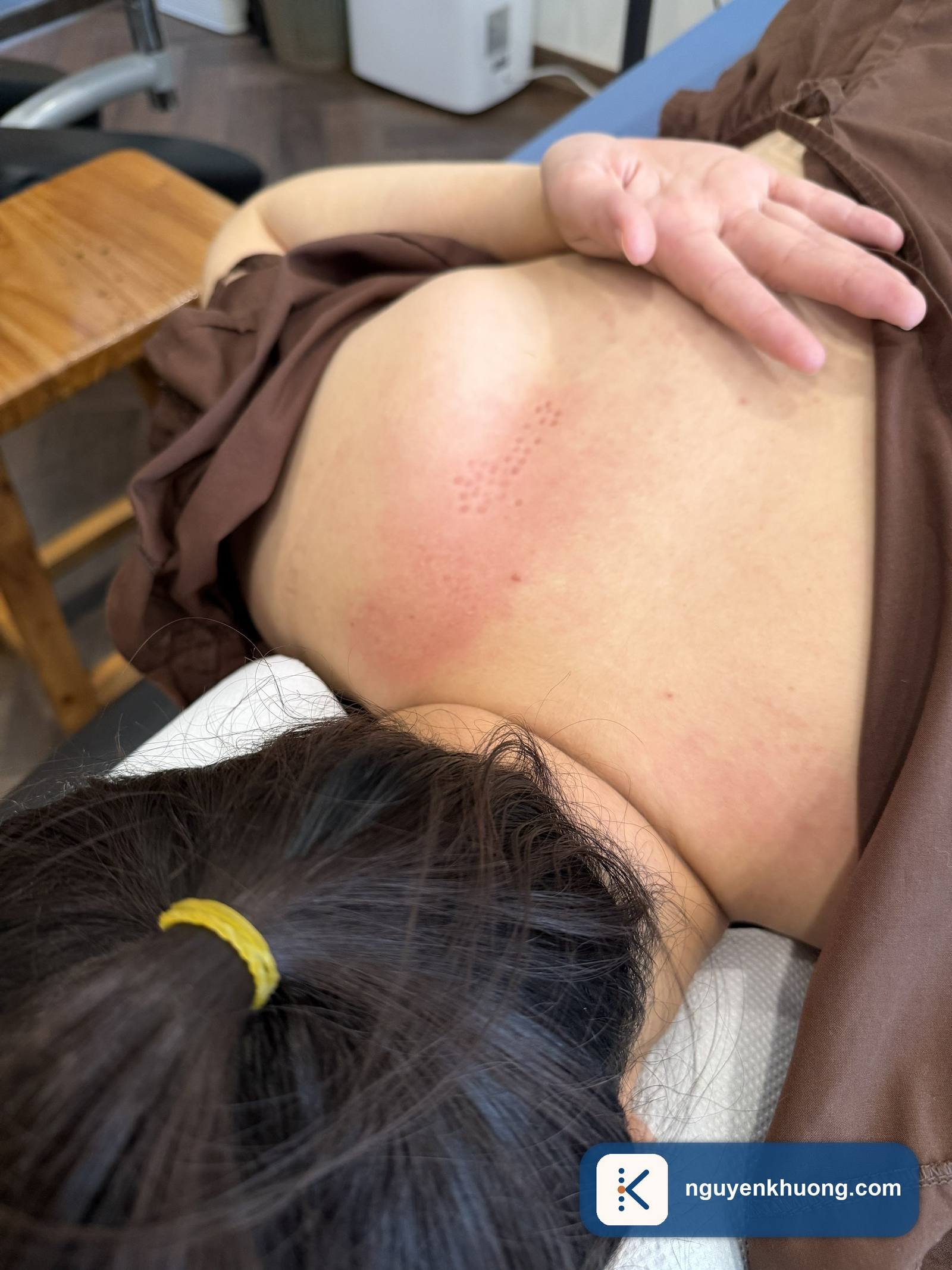 Chuyên gia dùng tay xác định điểm kích hoạt trên vai trước khi bấm huyệt giải cơ