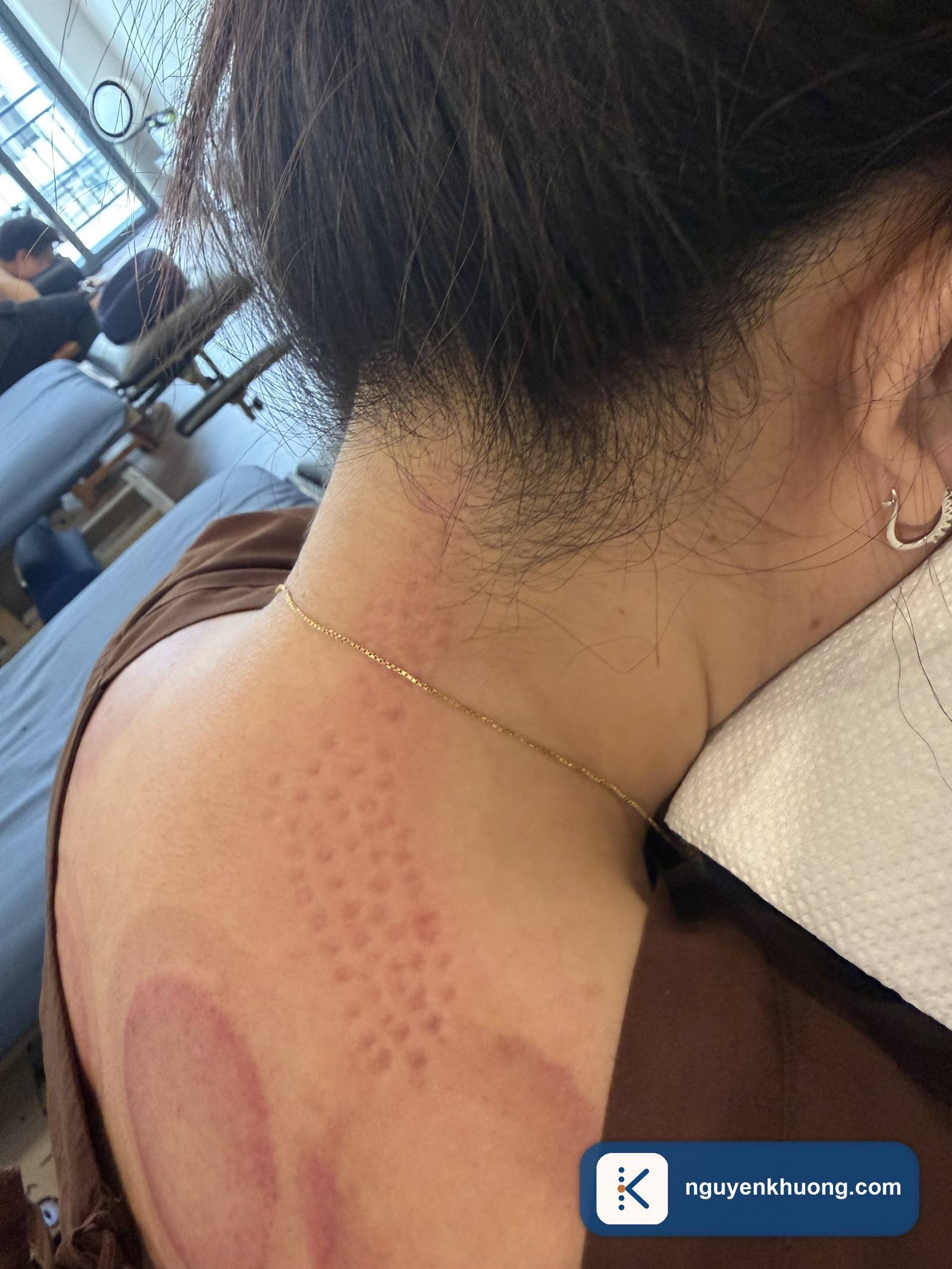 Vùng cổ vai gáy với các điểm bó cơ nổi rõ sau khi được tách xơ